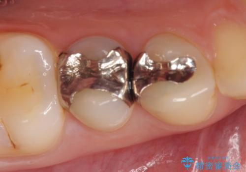 セラミックインレー 銀歯を白い歯への治療前