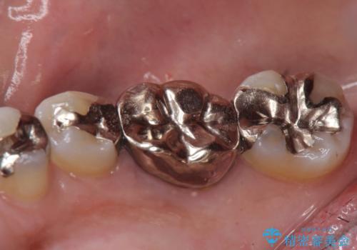 オールセラミッククラウン 他院にて根管治療を勧められた歯の治療の治療前