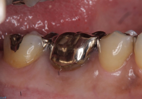 オールセラミッククラウン 他院にて根管治療を勧められた歯の治療の治療前