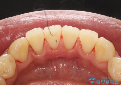 下の歯の裏側の着色の症例 治療後