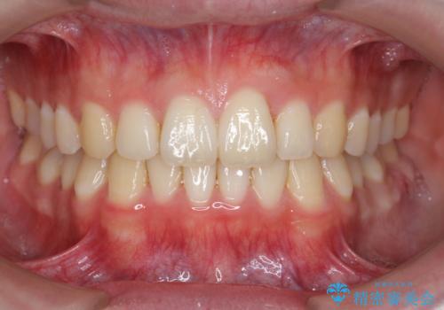 前歯のがたつき・すれちがい咬合を非抜歯で。流行の、格安マウスピースでは難しい、ワンランク上の治療の症例 治療後
