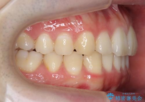 前歯のがたつき・すれちがい咬合を非抜歯で。流行の、格安マウスピースでは難しい、ワンランク上の治療の治療後