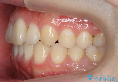 前歯のがたつき・すれちがい咬合を非抜歯で。流行の、格安マウスピースでは難しい、ワンランク上の治療の治療後