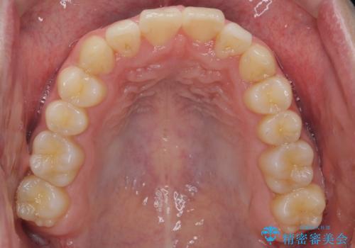 前歯のがたつき・すれちがい咬合を非抜歯で。流行の、格安マウスピースでは難しい、ワンランク上の治療の治療後