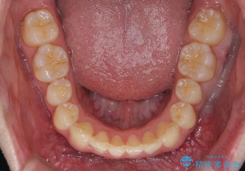前歯のがたつき・すれちがい咬合を非抜歯で。流行の、格安マウスピースでは難しい、ワンランク上の治療の治療後