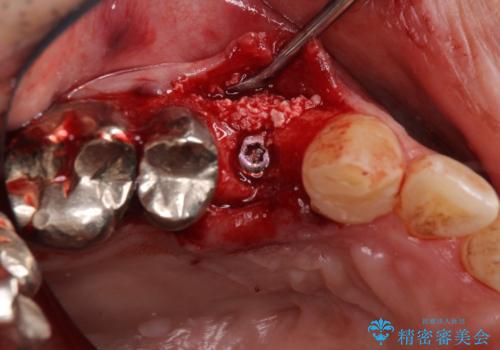 折れてしまった奥歯 インプラントによる補綴治療の治療中
