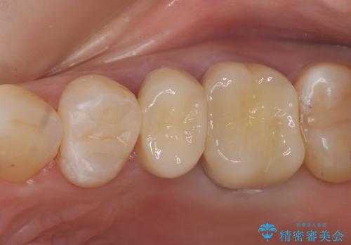 オールセラミッククラウン　セラミックインレー　銀歯を白い歯への治療後