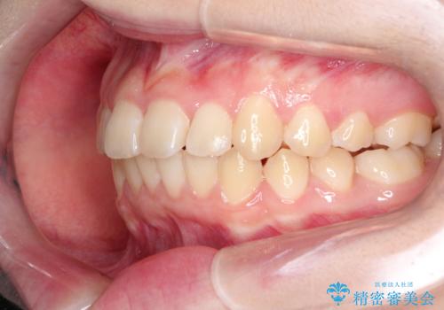 上下の前歯のガタガタを目立たず治したい インビザラインによる見えない矯正の治療後