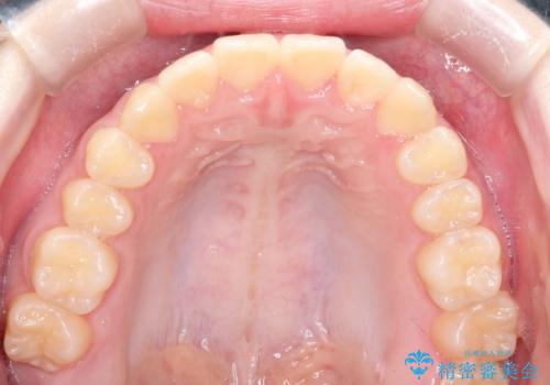 上下の前歯のガタガタを目立たず治したい インビザラインによる見えない矯正の治療後