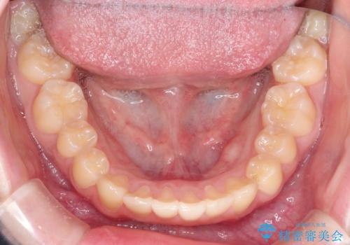 上下の前歯のガタガタを目立たず治したい インビザラインによる見えない矯正の治療後