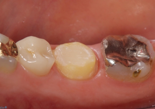 オールセラミッククラウン 神経が死んでいる歯の治療の治療中