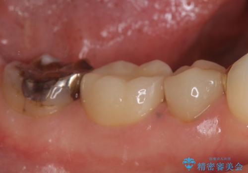 オールセラミッククラウン 神経が死んでいる歯の治療の症例 治療後