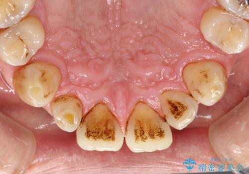 頑固な着色汚れを1日でキレイにの治療前