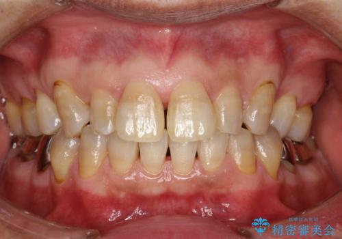 頑固な着色汚れを1日でキレイにの治療後
