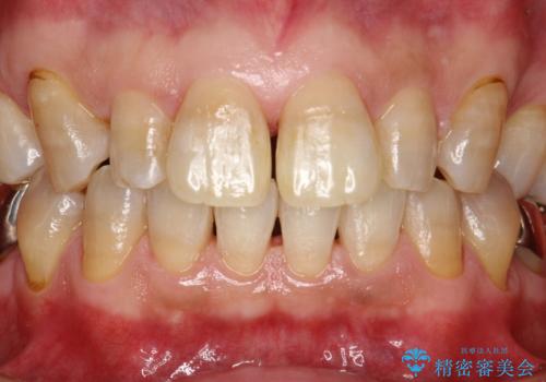 頑固な着色汚れを1日でキレイにの症例 治療後