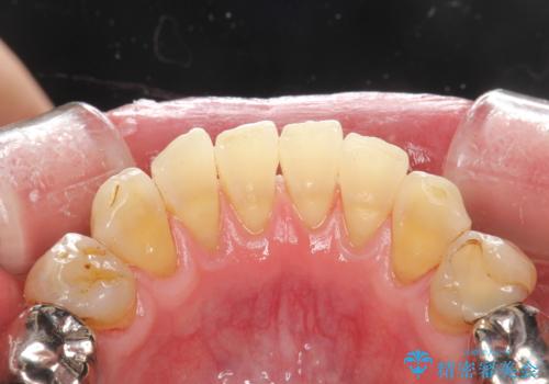 頑固な着色汚れを1日でキレイにの治療後