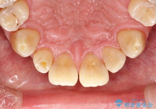 頑固な着色汚れを1日でキレイにの治療後