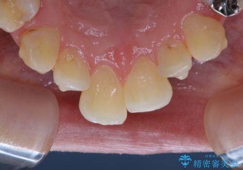 invisalign中のPMTCの治療前
