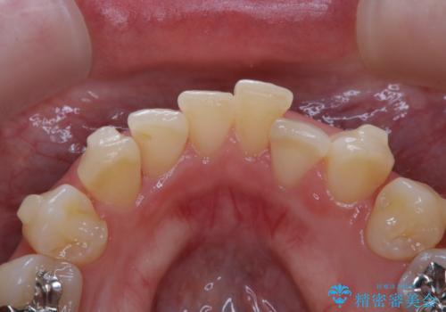 invisalign中のPMTCの治療前