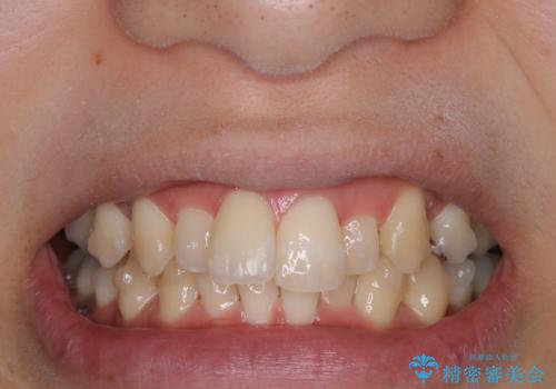 invisalign中のPMTCの症例 治療後