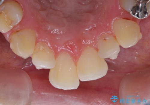 invisalign中のPMTCの治療後