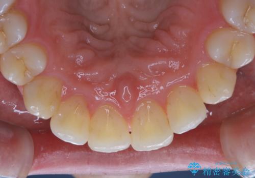 1年ぶりのPMTCで着色落としの治療前