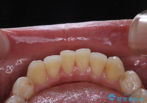 1年ぶりのPMTCで着色落としの治療前