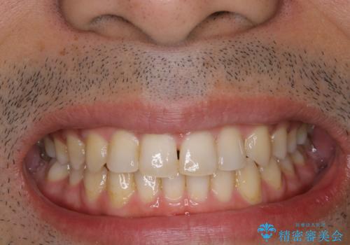 1年ぶりのPMTCで着色落としの治療前