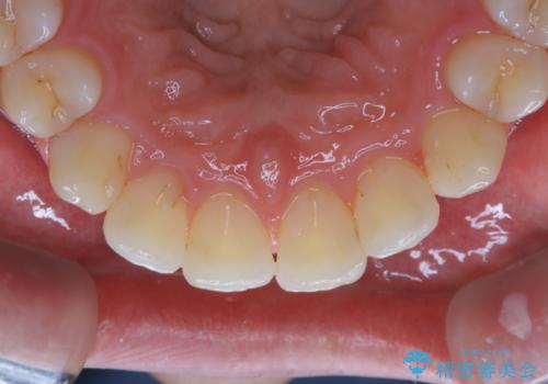 1年ぶりのPMTCで着色落としの治療後