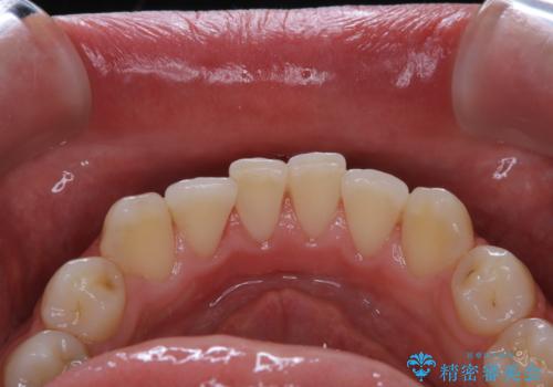 1年ぶりのPMTCで着色落としの治療後