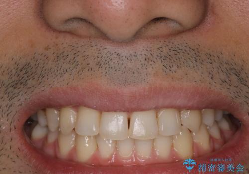 1年ぶりのPMTCで着色落としの治療後