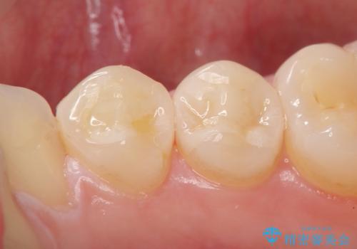 セラミックインレー 銀歯を白い歯への症例 治療後