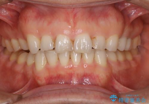 前歯のステイン(着色)をPMTCでキレイにの治療前