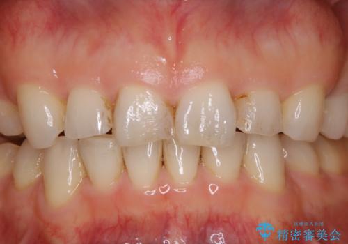 前歯のステイン(着色)をPMTCでキレイにの治療前