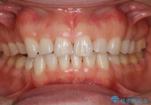 前歯のステイン(着色)をPMTCでキレイにの治療後