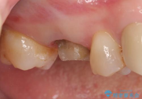 オールセラミッククラウン 他院にて治療困難と言われた歯の治療の治療中