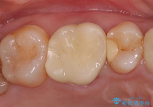オールセラミッククラウン 他院にて治療困難と言われた歯の治療の症例 治療後
