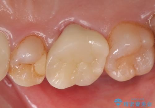 オールセラミッククラウン 他院にて治療困難と言われた歯の治療の治療後
