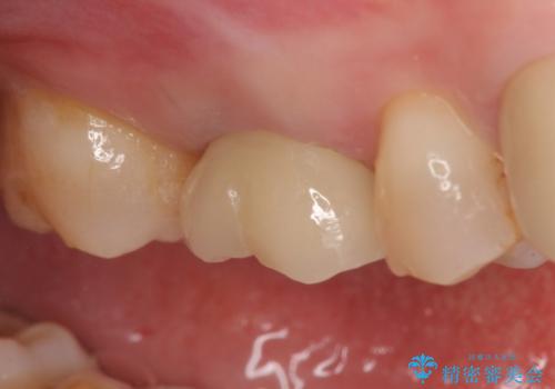 オールセラミッククラウン 他院にて治療困難と言われた歯の治療の治療後