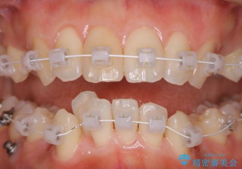 ワイヤー矯正中のクリーニング PMTCの治療後
