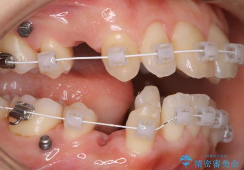 ワイヤー矯正中のクリーニング PMTCの治療後