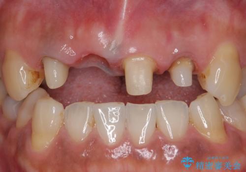 オールセラミッククラウン 折れてしまった前歯の治療の治療中