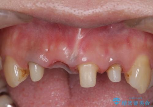 オールセラミッククラウン 折れてしまった前歯の治療の治療中