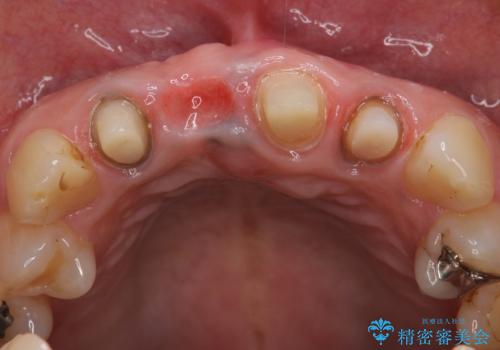 オールセラミッククラウン 折れてしまった前歯の治療の治療中