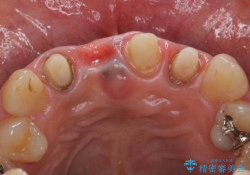 オールセラミッククラウン 折れてしまった前歯の治療の治療中