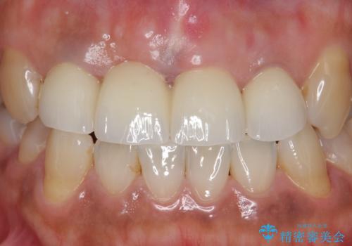 オールセラミッククラウン 折れてしまった前歯の治療の治療後