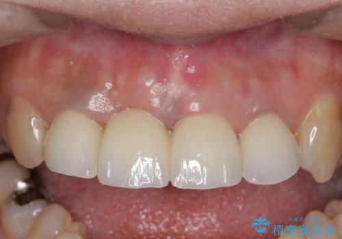 オールセラミッククラウン 折れてしまった前歯の治療の治療後