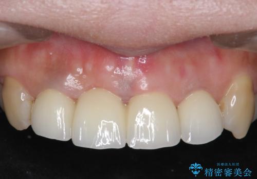 オールセラミッククラウン 折れてしまった前歯の治療の治療後