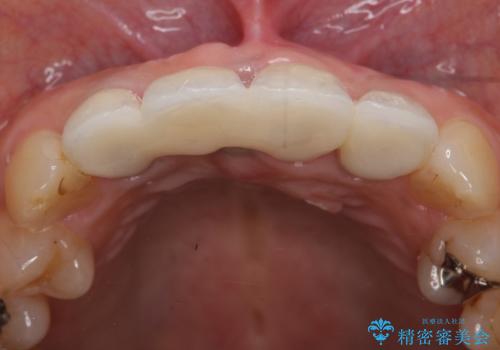 オールセラミッククラウン 折れてしまった前歯の治療の治療後