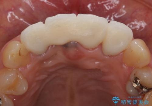 オールセラミッククラウン 折れてしまった前歯の治療の治療後